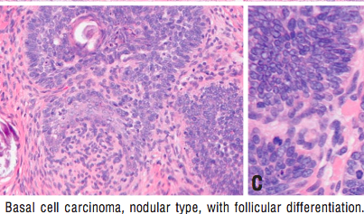 BCC_figures/BCC_adnexal2.png