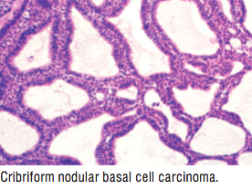 BCC_figures/BCC_cribriformnodular.png