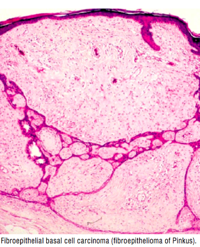 BCC_figures/BCC_fibroepithelial.png