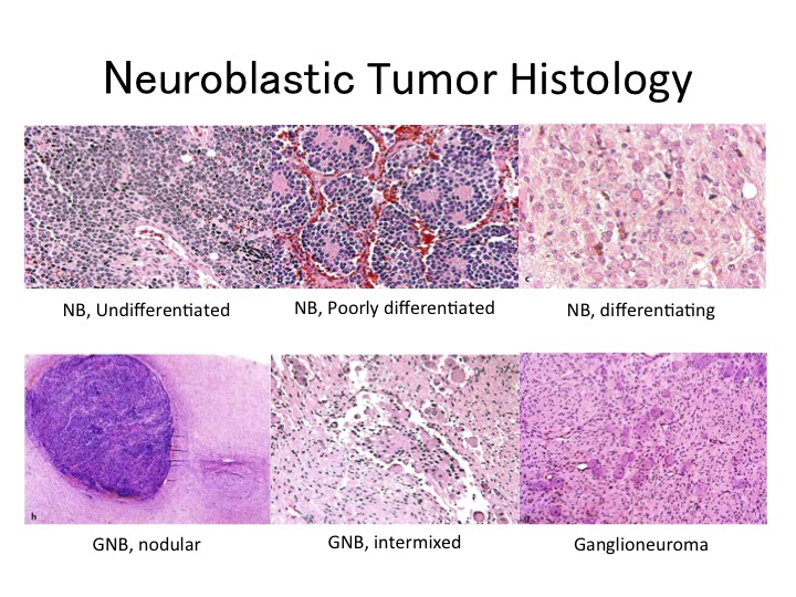 Neuroblastoma Classification