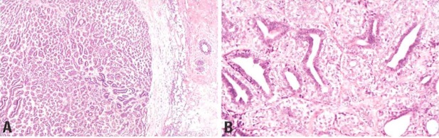 adenomyoepitheliomaadenosis.jpg