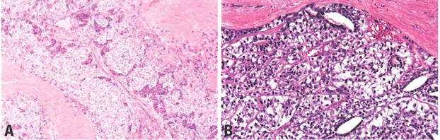 adenomyoepitheliomalobulated.jpg