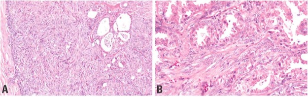 adenomyoepitheliomaspindle.jpg