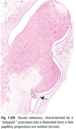 tubularadenoma.jpg