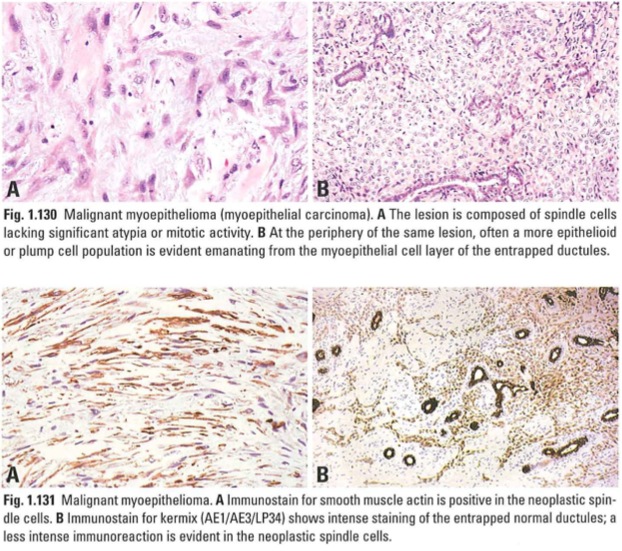 malignantmyoepithelioma.jpg