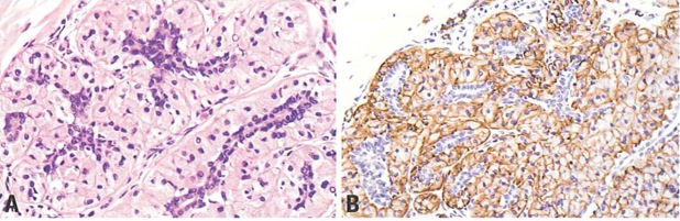 myoepitheliosisperiductal.jpg