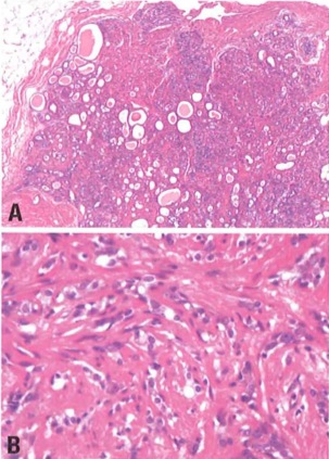 sclerosingadenosis.jpg