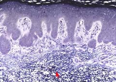 dermis elastic
          staining